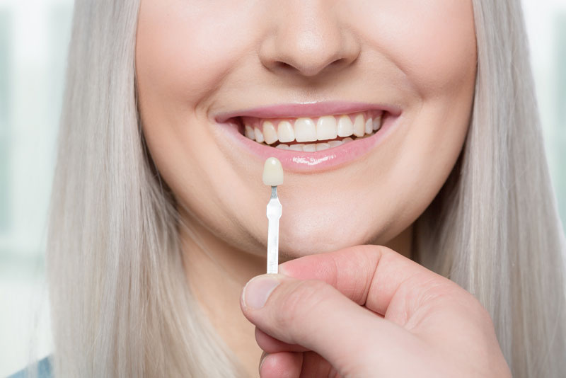 a dental veneers patient smiling