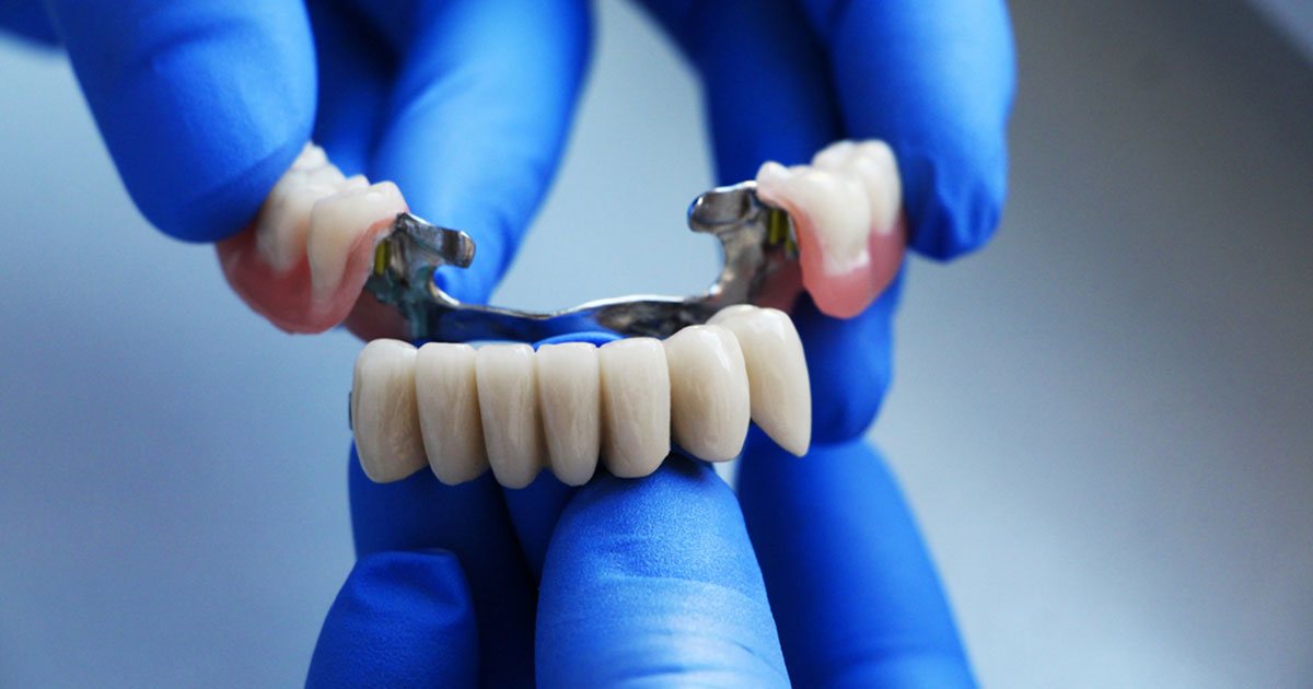 Dental Bridges vs. Implants