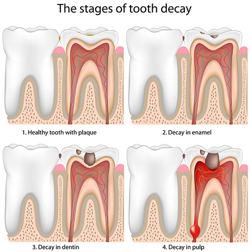 the stages of tooth decay