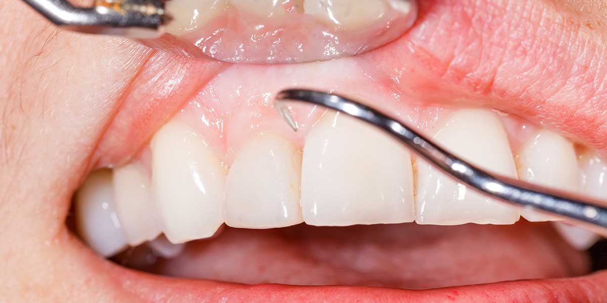image of a patients upper lip being lifted with a dental tool so the doctor can look at her white gums