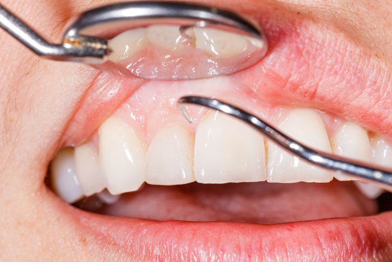Dental Patient With Gum Disease