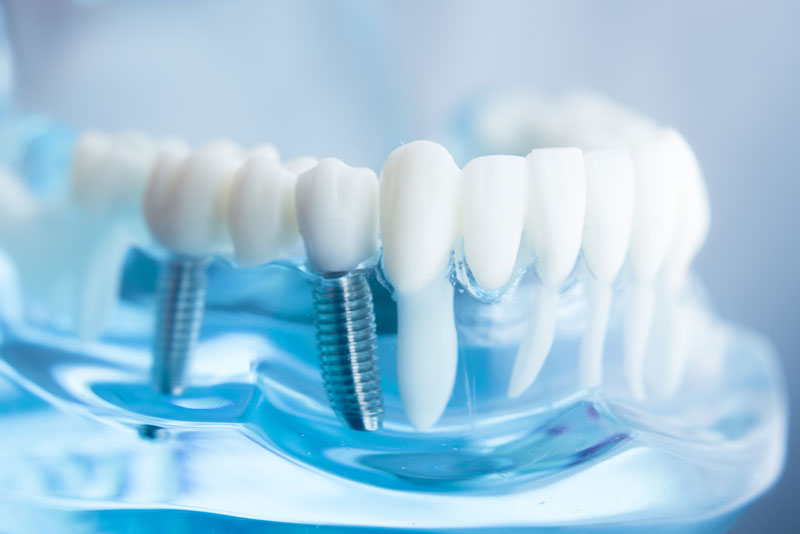 a full mouth dental implant model that shows the dental implants.