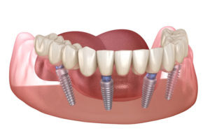 image of a full arch dental implant model showing the posts being implanted