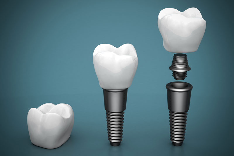 two dental implants and a crown