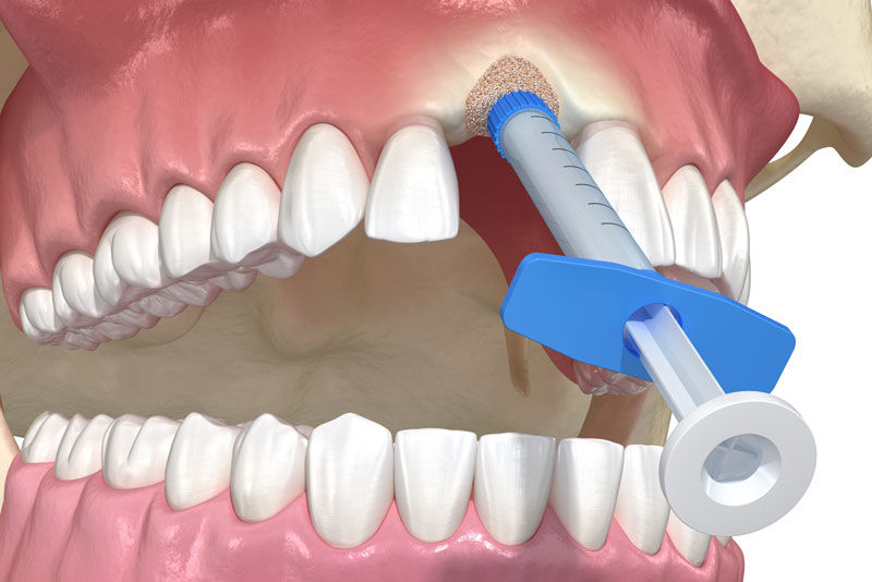 socket preservation and bone grafting to prepare for a dental implant.