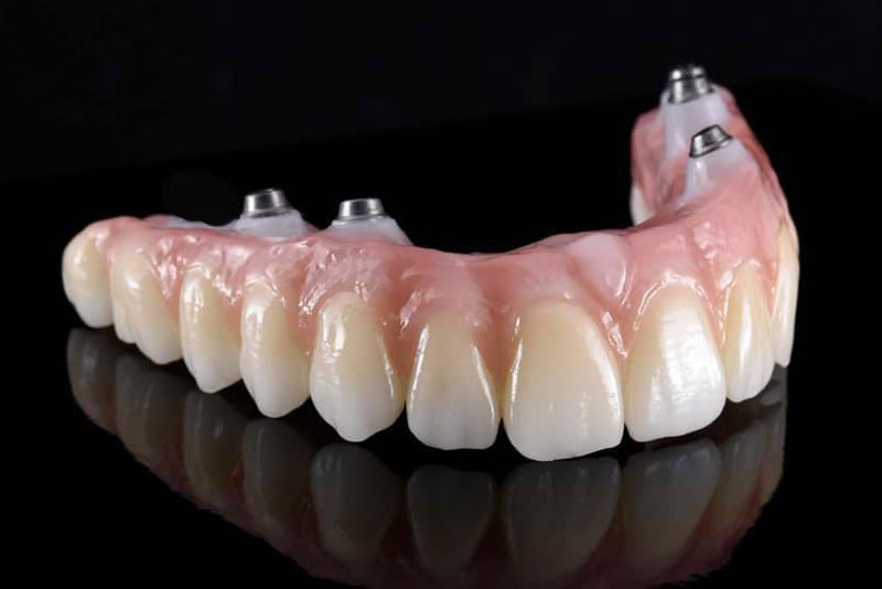 a zirconia full arch bridge that can benefit a patients smile when they get a zirconia fixed bridge procedure. the zirconia bridge has dental implants in them so they can be stabilized in the patients mouth.