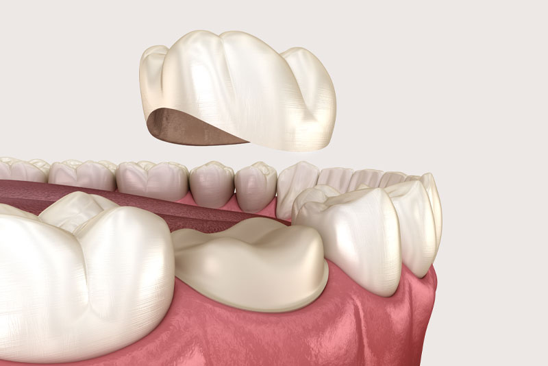 a digital model of a single dental crown.