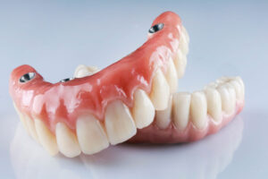 a set of full mouth dental implant model prosthesis.
