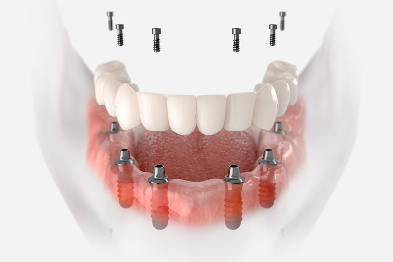 full mouth dental implant and post digital rendering.