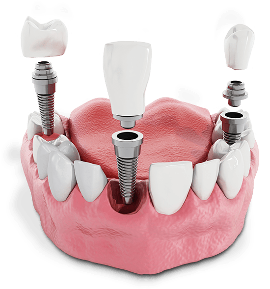 multiple dental implants model.