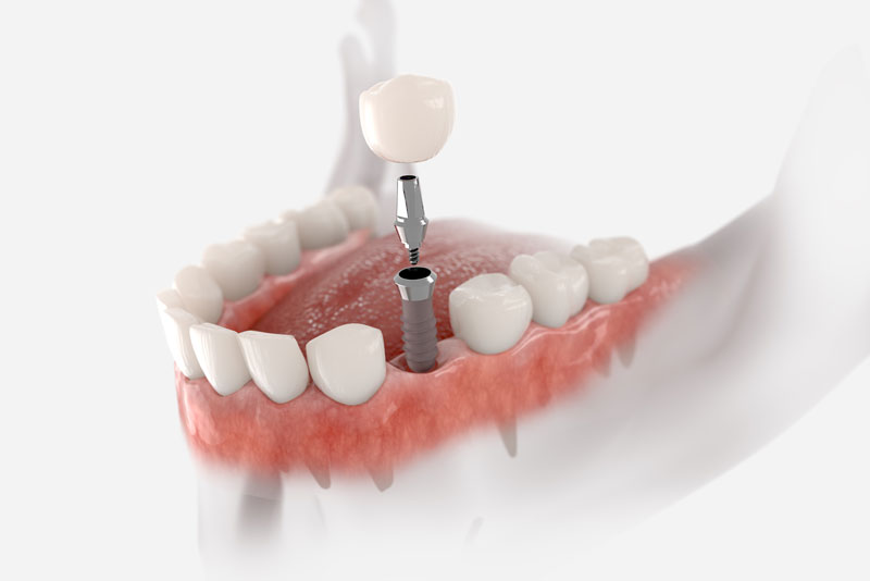 single dental implant and post digital rendering.